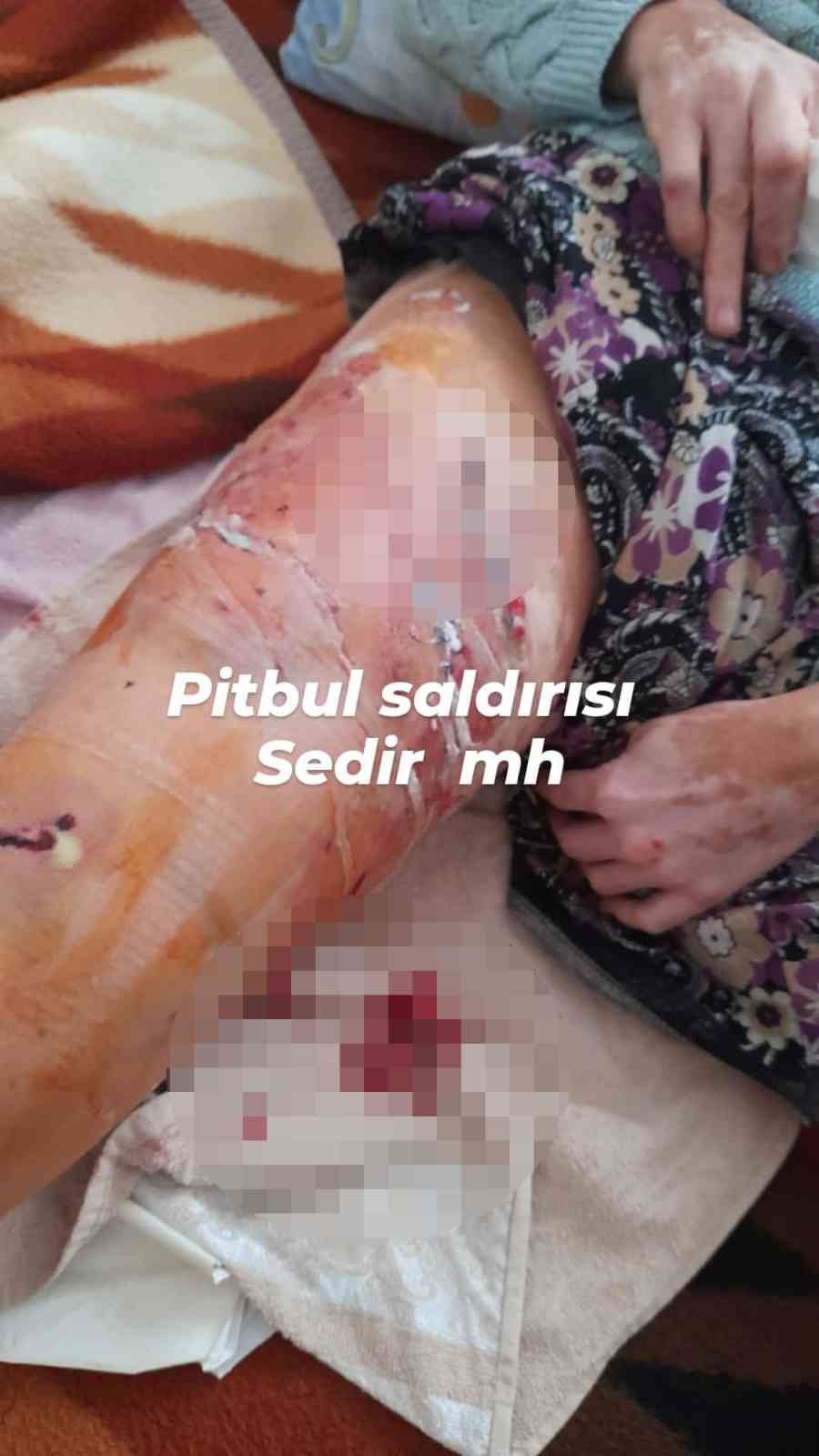Antalya’da 2 Pitbullun Saldırısına Uğrayarak Ölümden Dönen Kadın: “gitti Geldi Tekrar Isırdı”